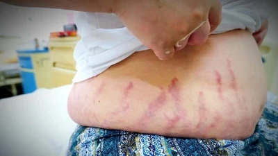 Từ con dị ứng mũi tự điều trị thành suy tuyến thượng thận