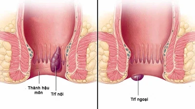 Bác sĩ chỉ rõ “kẻ thù giấu mặt” gây trĩ, hiểu đúng phòng ngừa hiệu quả