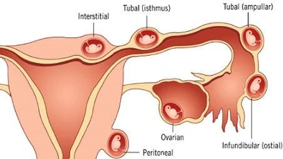 Cứu sản phụ sốc do chửa ngoài tử cung đã vỡ, bảo toàn thai 2 tháng