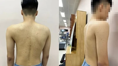 Khám sàng lọc, chẩn đoán hình ảnh miễn phí bệnh gù, vẹo cột sống trẻ em
