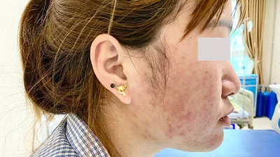 Tự uống thuốc ho và dạ dày người bệnh 30 tuổi bị sốc phản vệ
