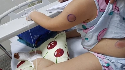 Bị gà mổ, bé 5 tuổi ở Quảng Bình nhiễm khuẩn Whitmore 
