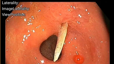 Cụ bà bị xương cá 4cm đâm thủng dạ dày gây phù nề, dịch mủ