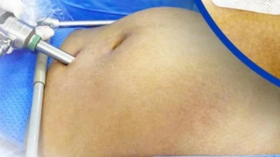 U nang buồng trứng khiến bụng người phụ nữ to như mang thai 4 tháng