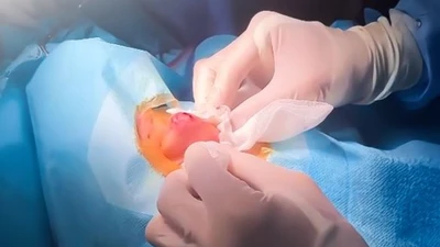 Tự nặn mụn nam thanh niên bị... viêm áp xe vùng mũi