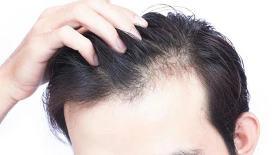 Hói đầu, rụng tóc ở nam giới trẻ, dấu hiệu cảnh báo từ hormone, stress?