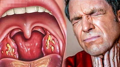 Cách trị dứt điểm viêm họng trong 4 giờ cực đơn giản 