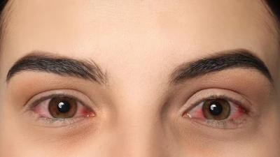 Đau mắt đỏ lây qua đường nào?