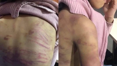 Hà Nội: Bé gái 12 tuổi nghi bị mẹ đẻ bạo hành, người tình của mẹ hãm hiếp