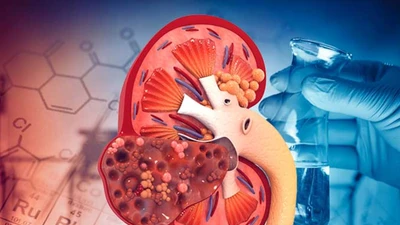 Thói quen xấu hàng ngày dễ dẫn đến suy thận