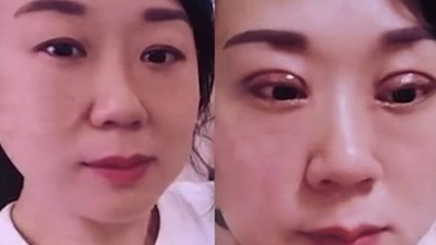 Vợ cắt mí thất bại, chồng ngày nào cũng đòi ly hôn