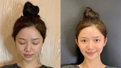 Hết hồn mốt phẫu thuật thẩm mỹ tai yêu tinh và tạo chân thon