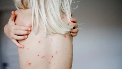 Sự thật kinh hoàng bé trai 11 tuổi bị giang mai 