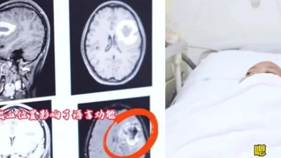 Cô gái bỗng dưng "quên" tiếng Anh: Bác sĩ phát hiện nguyên nhân bất ngờ