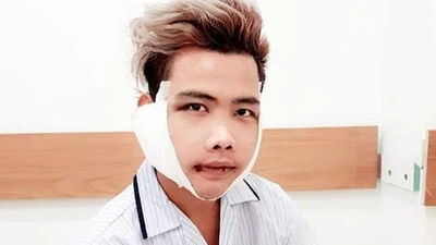 "Giật mình" trước nhan sắc của Tùng Sơn sau phẫu thuật thẩm mỹ