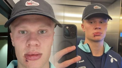 Haaland phải khâu 3 mũi sau tai nạn hy hữu, Odegaard bị réo tên là "thủ phạm"