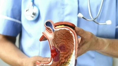 80% ca ung thư dạ dày đến từ một nguyên nhân quen thuộc