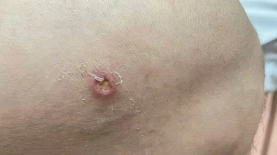 Phát hiện thêm ca bệnh giun rồng thứ 26 tại Phú Thọ