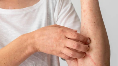 Nhiều bệnh da liễu phát triển trong mùa hè