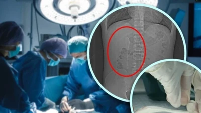 Người đàn ông nuốt thìa vào bụng khi say rượu, 5 tháng sau mới phát hiện ra
