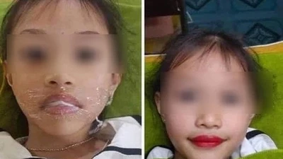 TMV phun môi bé gái 5 tuổi: Trẻ đối mặt nguy cơ gì?