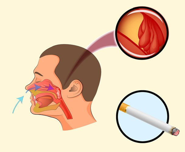 Bỏ thuốc lá: Thuốc lá kích thích niêm mạc khoang mũi và cổ họng làm cho nó sưng lên và phát triển viêm. Khi đường mũi bị tắc nghẽn do hút thuốc lá thì sẽ khó thở qua mũi vì luồng không khí bị giảm. Ngay cả những người không hút thuốc nhưng hít khói thuốc từ những người hút thuốc khác có nhiều khả năng bị viêm mãn tính ở mũi và cổ họng, làm tăng nguy cơ ngáy.