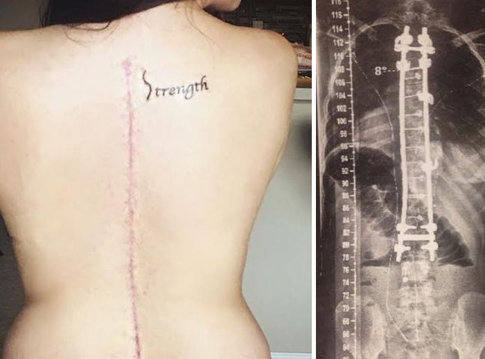 Người phụ nữ này đã thông minh khi xăm dòng chữ Strength (sức mạnh) để phụ họa cho vết sẹo dài trên sống lưng của mình.