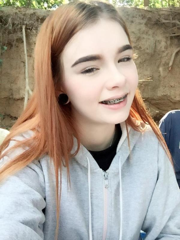 Bức ảnh niềng răng của Jessie Vard.