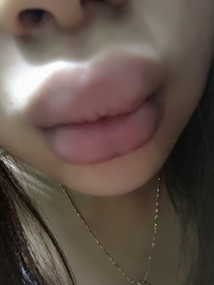 Mới đây, câu chuyện của người dùng có nickname L.C là minh chứng gần nhất. Đôi môi của cô gần như đã biến dạng, sưng tấy, đỏ ứng lên một cách bất thường với nguyên nhân được cho là kích ứng với mỹ phẩm.