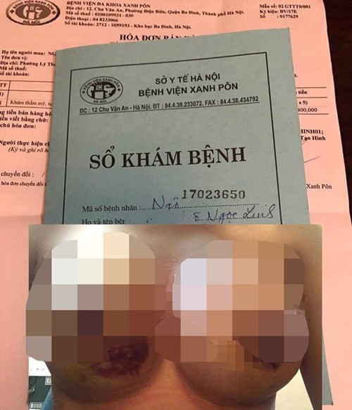 Ở diễn biến khác, thông tin một người phụ nữ tên L. ở Hà Nội sau khi phẫu thuật nâng ngực ở BV thẩm mỹ Kim Cương A&B (Yết Kiêu - Hà Nội) đã có hiện tượng sưng tấy, rỉ máu gây xôn xao dư luận tuần qua. Liên quan vụ bệnh nhân nâng ngực ở Bệnh viện thẩm mỹ Kim Cương, ngày 24/5/2017, Bộ Y tế đã có công văn chỉ đạo về vụ việc này.