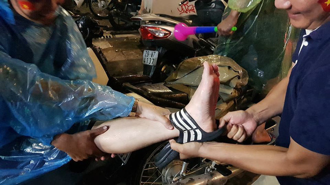 Giữa biển người đang hừng hực khí thế chúc mừng thành công của đội tuyển U23 Việt Nam, mọi người đồng thời cũng chứng kiến không ít những sự cố, những tai nạn hy hữu như câu chuyện của chàng thanh niên dưới đây.