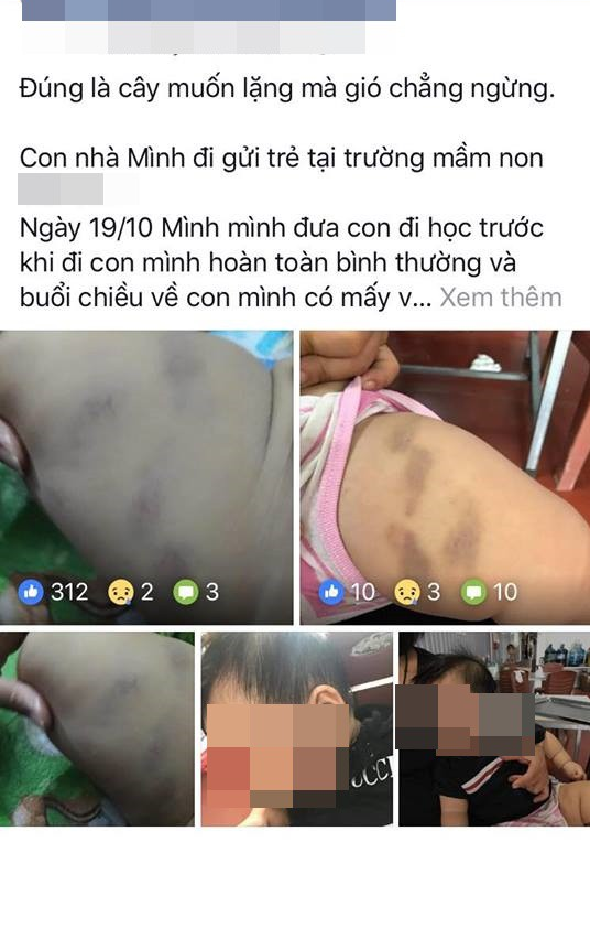 Mới đây trên một fanpage quy tụ nhiều các bà mẹ bỉm sữa trên MXH, một bà mẹ trẻ đã đăng tải ghi lại những bức hình con trai mình với những vết bầm tím trên người và cùng với đó là câu chuyện tố cáo nhà trường bạo hành trẻ em.