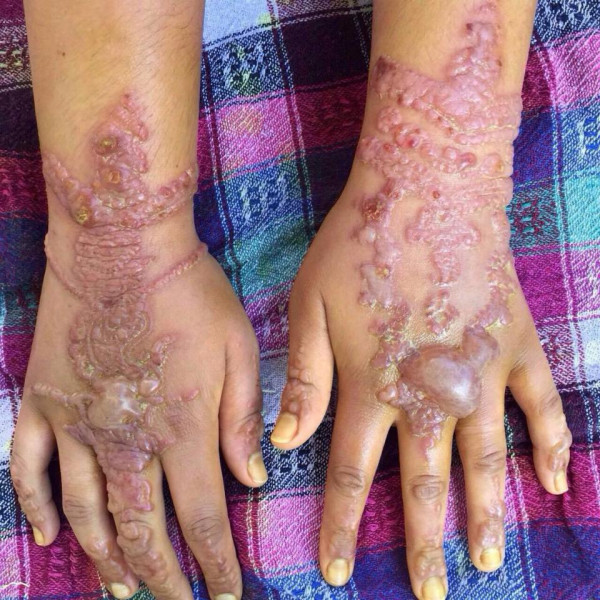 Trước đó đã có nhiều trường hợp đã bị kích ứng da từ việc xăm henna. Chính vì vậy, tại Mỹ, mực xăm Henna đã bị cấm hoàn toàn; trong khi tại châu Âu, loại mực này không bị cấm nhưng đã có những cảnh báo khi chất này được trộn trong mực xăm.