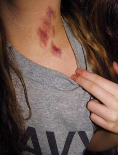Nụ hôn tử thần hay có tên tiếng Anh là Hickey Kiss là hình ảnh mà không ít các bạn trẻ từng bắt gặp trên MXH. Đây là dấu vết được cho là đánh dấu "lãnh thổ" của các cặp đôi đang yêu nhau với đối phương. Tuy nhiên, ít ai biết rằng, ẩn sâu trong những cái hôn kiểu ngấu nghiến này là tiềm tàng của nhiều bệnh tật, thậm chí còn nguy hiểm đến tính mạng