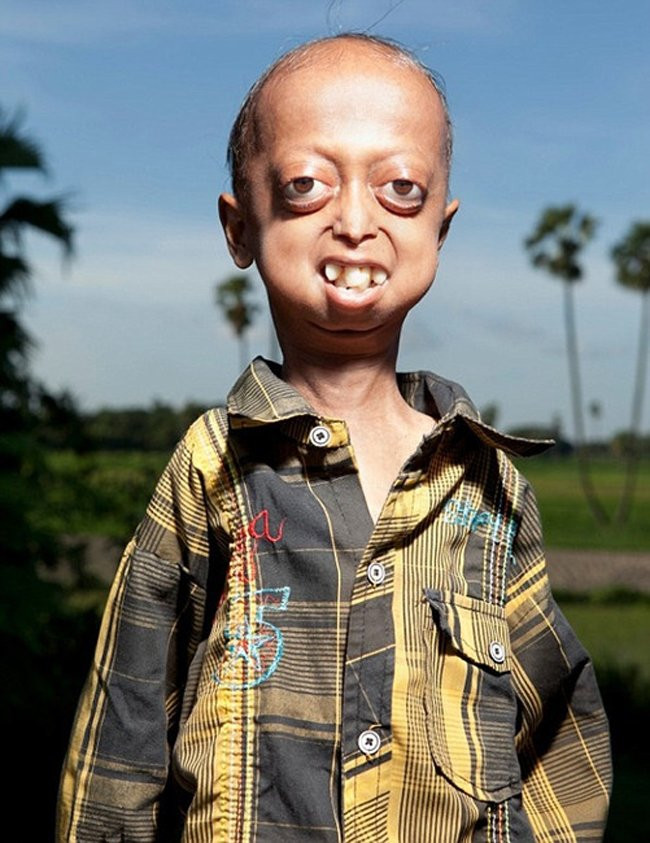 Cậu bé Ali Hussain Khan, 14 tuổi, người Ấn Độ trông già như ông lão 60 tuổi do mắc phải chứng lão hóa sớm. Hai anh em trai và ba chị em gái của Ali đều đã qua đời vì chứng bệnh hiếm gặp nhất thế giới này.