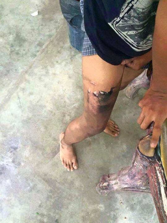 Nguyên nhân của sự việc là do trước đó chiếc điện thoại đã được chủ nhân sử dụng khá nhiều, được đặt trong chiếc quần jeans chật nên pin điện thoại đã phồng lên rồi phát nổ. Sự cố đã khiến một bên chân của nam thanh niên bị bỏng rát khá nghiêm trọng.