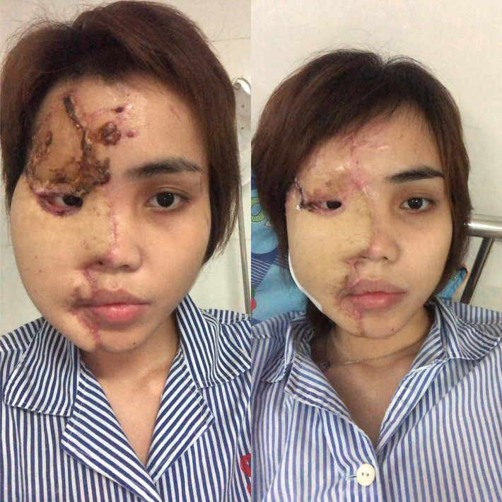 Từ một cô gái trẻ trung, xinh đẹp, gương mặt của Lê Thị Lan Vy, 24 tuổi ở Đà Nẵng đã bị hủy hoại sau khi bị chồng sắp cưới là thiếu úy PCCC Nguyễn Trương Nam Hải tạt axit vào đúng ngày 1/1/2019.