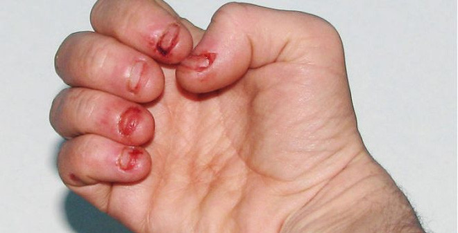 Có những người tay xấu do "cha sinh mẹ đẻ" đã như vậy nhưng cũng có cô nàng tay ngày càng xấu, móng ngày càng ngắn lý do cắn móng tay.