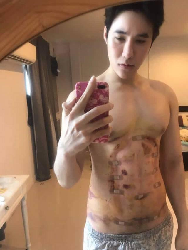 Theo nhiều người, việc phẫu thuật thẩm mỹ để có body 6 múi như trên ảnh hưởng nhiều tới sức khỏe. Trong khi đó, nếu tập thể dục để có thân hình chuẩn sẽ tốt hơn.