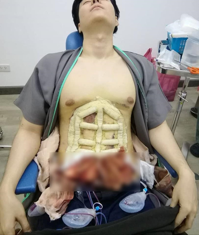 Thay vì dành thời gian cho việc tập luyện thể thao, chế độ ăn uống hợp lý, chàng trai trên ảnh đã chọn cách phẫu thuật thẩm mỹ 6 múi để đạt được mục đích nhanh nhất.