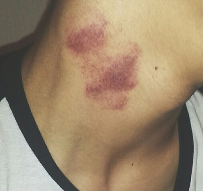 Những dấu hôn được gọi là hickey hay "ấn dâu tây", là một trong những cách thể hiện tình yêu cuồng nhiệt của một số bạn trẻ.