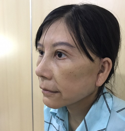 Dưới sự giúp đỡ tận tình của các y bác sĩ đầu ngành đến từ Hàn Quốc, Nguyễn Thị Như có một diện mạo hoàn toàn mới sau 15 ngày phẫu thuật.