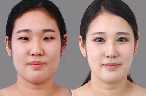 Tạo mắt hai mí. Người phương Tây rất ấn tượng với đôi mắt một mí của các cô gái châu Á và ví nó là mắt hình hạnh nhân.