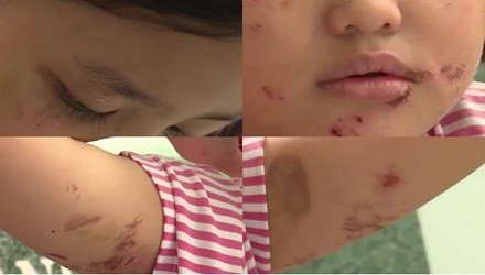 7. Bé gái 6 tuổi bị cha ruột dùng lửa đốt khắp người. Mới đây, cơ quan chức năng tỉnh Bình Dương phát hiện một bé gái 6 tuổi bị chính cha ruột của mình dùng lửa đốt khắp người bé. Nạn nhân vụ bạo hành trên là một bé gái mới học lớp 1. Bé gái này đang ở trọ cùng bố mẹ tại một khu trọ thuộc thị xã Thuận An, tỉnh Bình Dương.