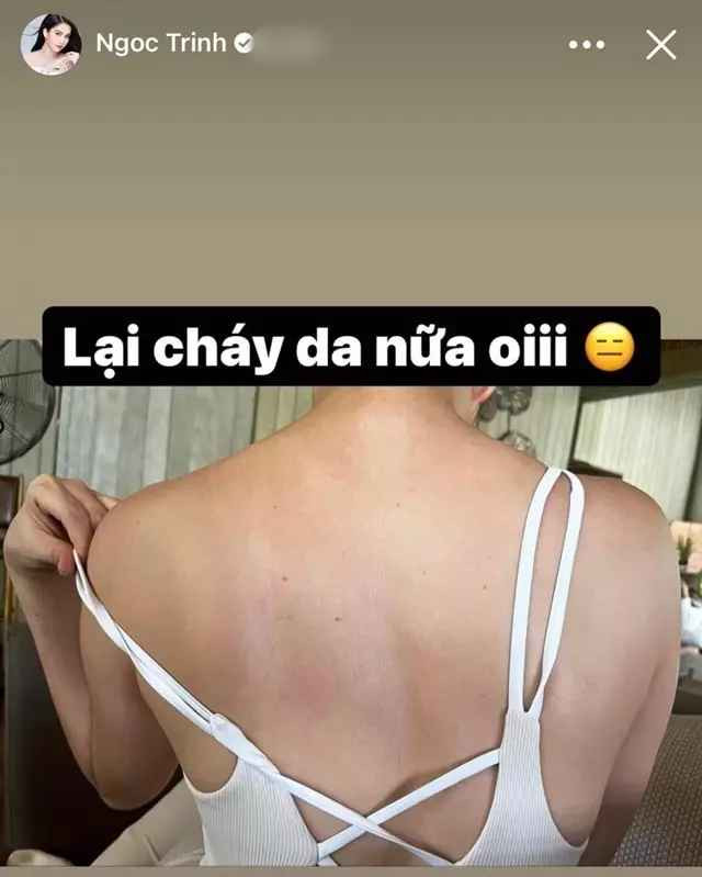 Hậu quả là "nữ hoàng nội y" toang luôn làn da trắng "thương hiệu" của mình.