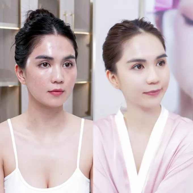 Trên thực tế, để sở hữu làn da trắng bóc không tì vết, Ngọc Trinh luôn thẳng thắn thừa nhận có tắm trắng và truyền trắng từ năm 2009.