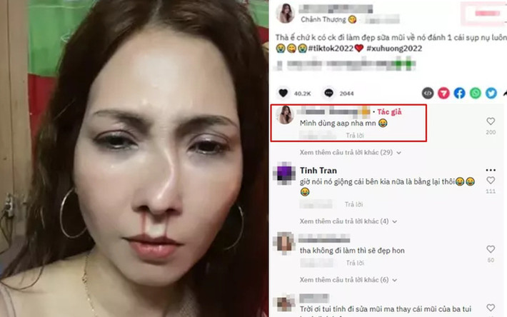 Cách đây không lâu, một người phụ nữ đã đăng clip lên TikTok hình ảnh nâng mũi bị gãy cong khiến nhiều người hốt hoảng. Kèm theo hình ảnh, nữ chính còn đính kèm dòng tiêu đề: "Thà ế chứ không có chồng. Đi làm đẹp, sửa mũi về nó đánh một cái sụp nụ luôn".