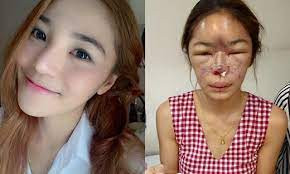 Cách đây không lâu, trên các fanpage nhiều cô nàng đã chia sẻ về hình ảnh nâng mũi bị hỏng của mình khiến ai nhìn thấy cũng phát sợ.