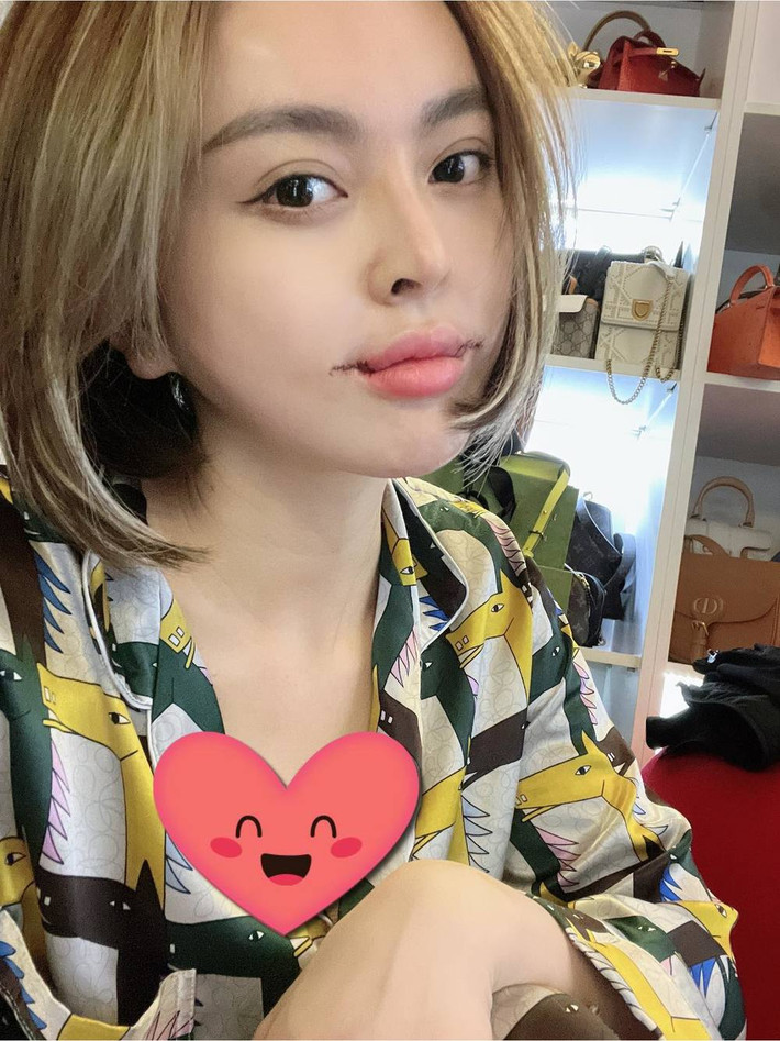 Vì vừa phẫu thuật xong và vết thương vẫn còn chưa lành, dấu vết dao kéo vẫn còn rất rõ trên miệng Trang Nemo.