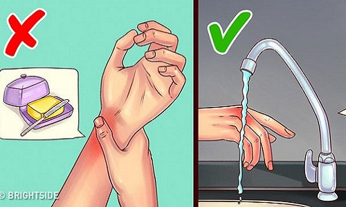 Chữa bỏng; Nhiều người có thói quen khi bị bỏng thường bôi lớp bơ hoặc dầu lên vết thương. Tuy nhiên, chính điều này làm vết bỏng lâu dịu hơn. Biện pháp tốt nhất là bạn nên làm mát vết thương bằng nước sạch, lạnh.